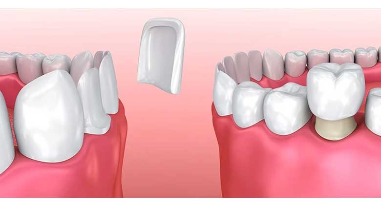 Differences between composite and dental laminate