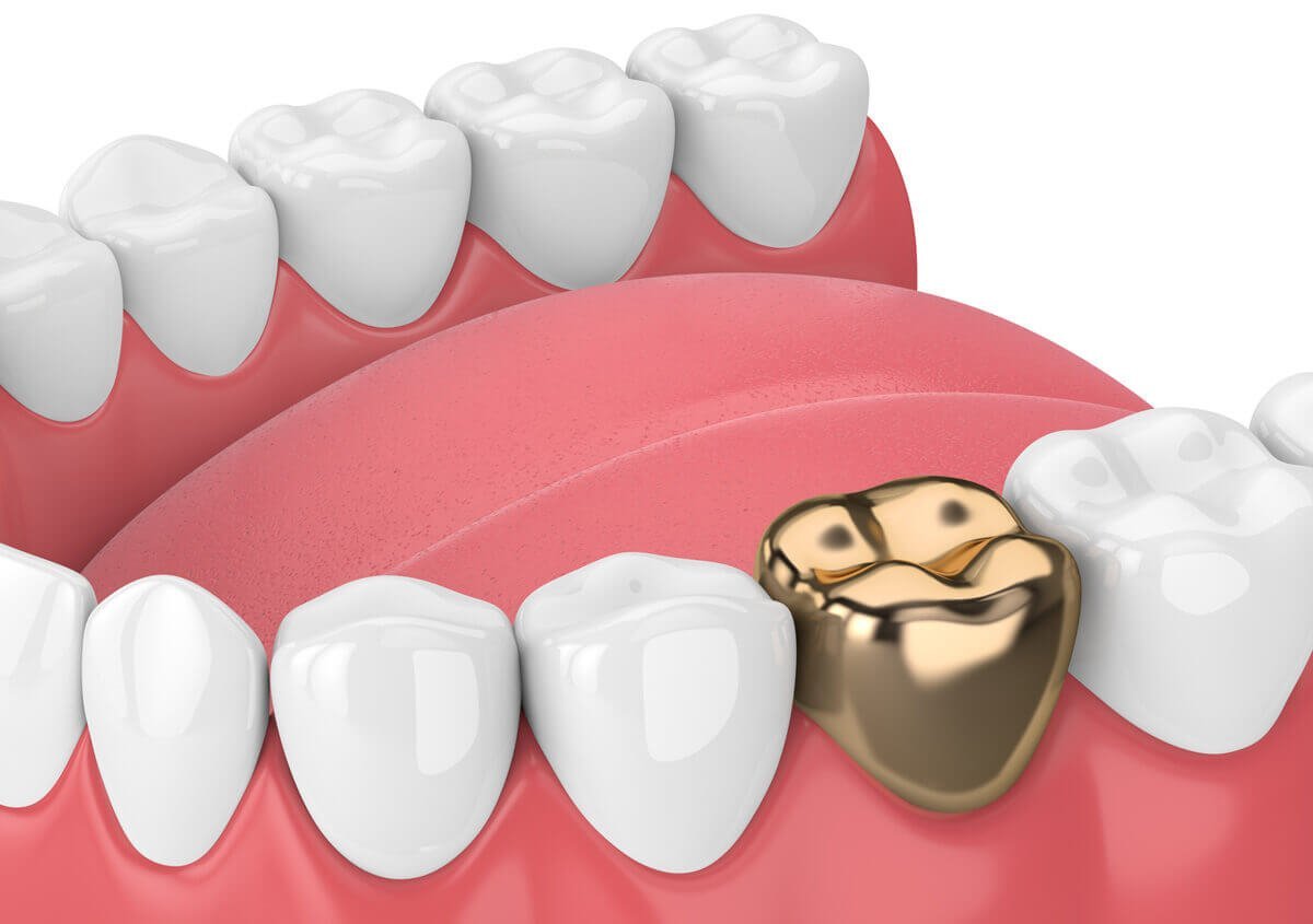 Gold Tooth Crown