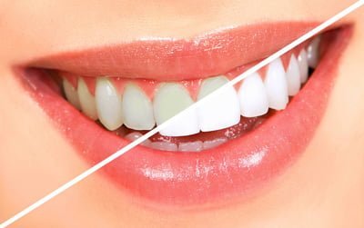 عکس از سفید کردن دندان