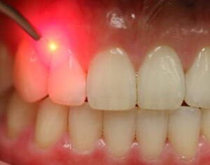 عکس کشیدن دندان با لیزر 