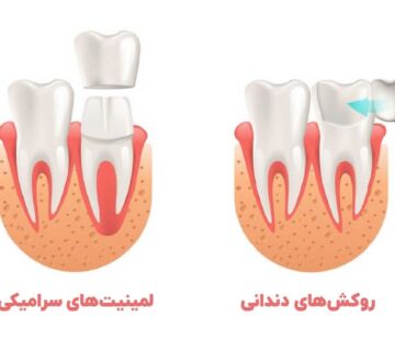 عکس از روکش دندان و لمینت دندان