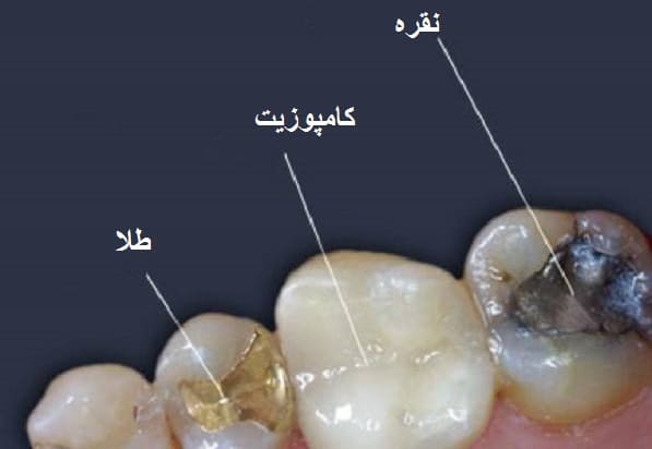 عکس از پوسیدگی دندان