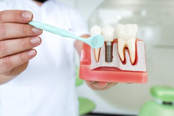 عکس از مراقبت از ایمپلنت دندان