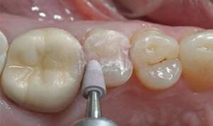 عکس از بیلداپ یا بازسازی دندان 