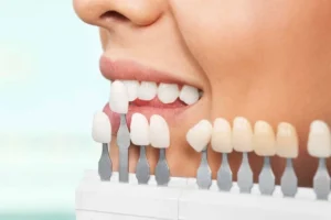 عکس از تعویض لمینت دندان 